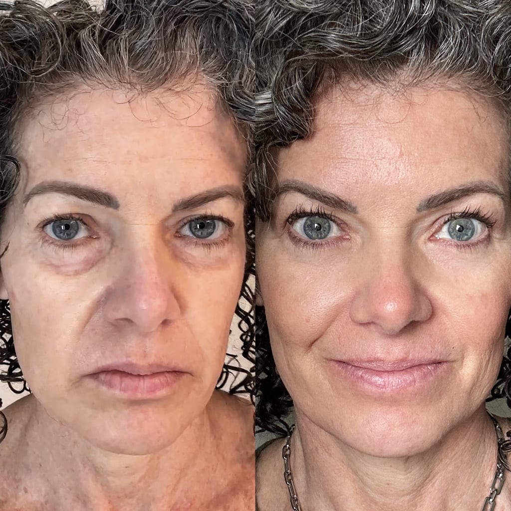 Red Light Therapy | Lumière® Bellucci Skin Milan